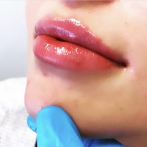 Anne Hegarty Cosmeticare - Lip Flip